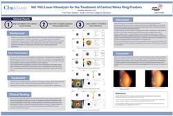 Nd YAG Laser Vitreolysis for the Treatment of Central Weiss Ring Floaters